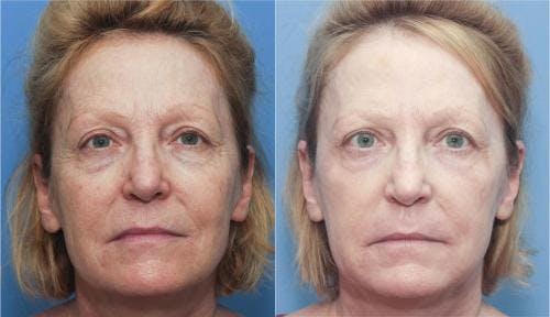 Contour TRL Laser Before & After Gallery - Patient 58214372 - Image 1