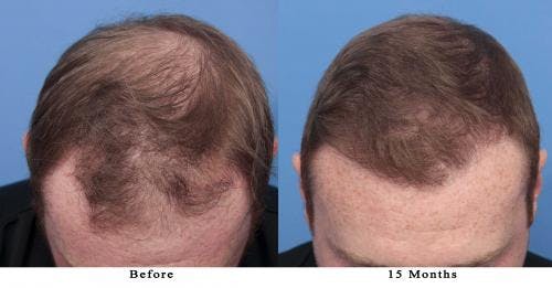NeoGraft Hair Restoration Before & After Gallery - Patient 58214371 - Image 2
