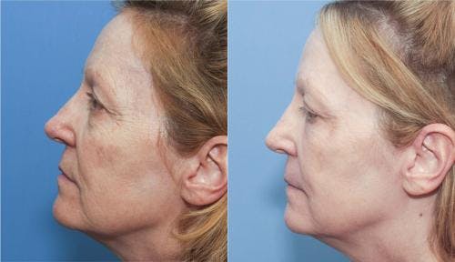 Contour TRL Laser Before & After Gallery - Patient 58214372 - Image 2