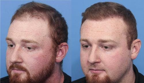NeoGraft Hair Restoration Before & After Gallery - Patient 58214371 - Image 3