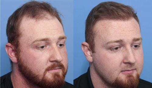 NeoGraft Hair Restoration Before & After Gallery - Patient 58214371 - Image 4