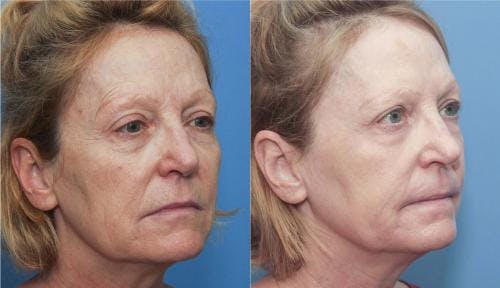 Contour TRL Laser Before & After Gallery - Patient 58214372 - Image 4