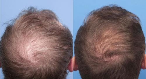 NeoGraft Hair Restoration Before & After Gallery - Patient 58214371 - Image 5