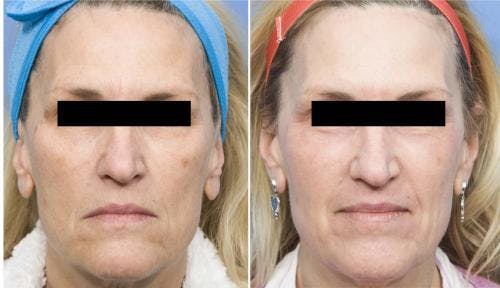 Contour TRL Laser Before & After Gallery - Patient 58214374 - Image 1