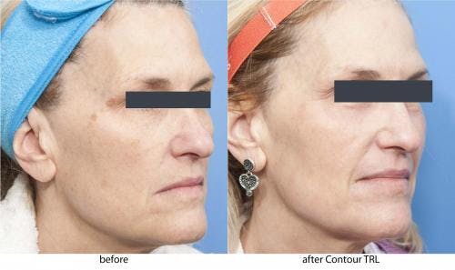 Contour TRL Laser Before & After Gallery - Patient 58214374 - Image 2