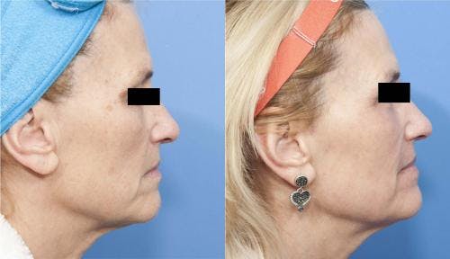 Contour TRL Laser Before & After Gallery - Patient 58214374 - Image 3