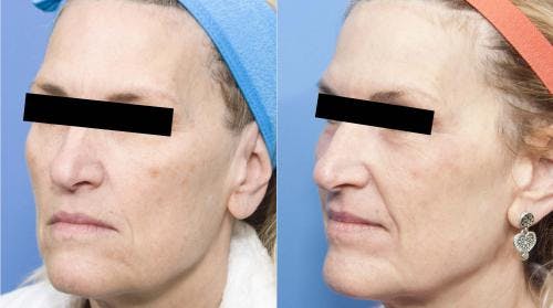 Contour TRL Laser Before & After Gallery - Patient 58214374 - Image 4