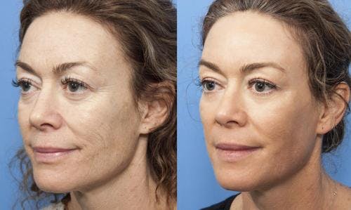 Contour TRL Laser Before & After Gallery - Patient 58214375 - Image 2