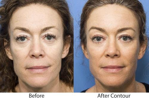 Contour TRL Laser Before & After Gallery - Patient 58214375 - Image 1