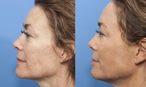 Contour TRL Laser Before & After Gallery - Patient 58214375 - Image 3