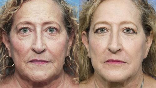 Contour TRL Laser Before & After Gallery - Patient 58214379 - Image 1