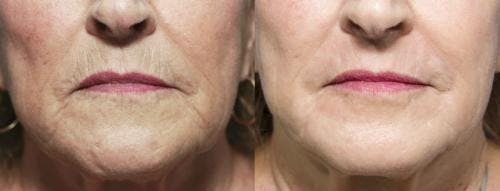 Contour TRL Laser Before & After Gallery - Patient 58214379 - Image 2