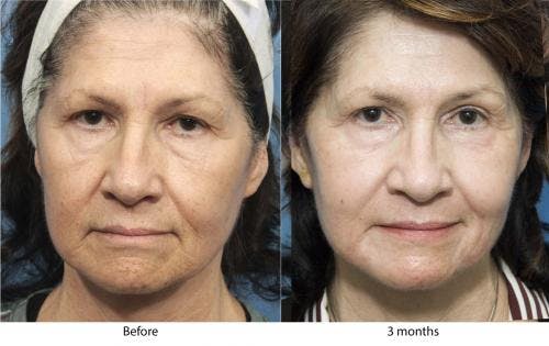 Contour TRL Laser Before & After Gallery - Patient 58214380 - Image 1