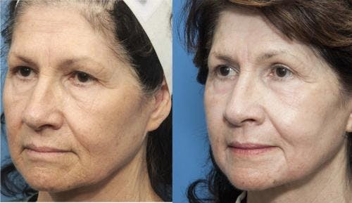 Contour TRL Laser Before & After Gallery - Patient 58214380 - Image 2