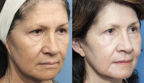 Contour TRL Laser Before & After Gallery - Patient 58214380 - Image 3
