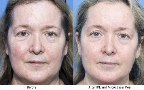Contour TRL Laser Before & After Gallery - Patient 58214381 - Image 1