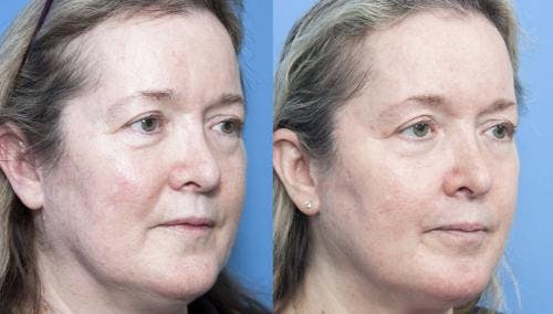 Contour TRL Laser Before & After Gallery - Patient 58214381 - Image 2