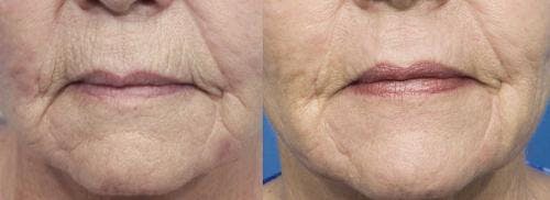 Contour TRL Laser Before & After Gallery - Patient 58214382 - Image 1