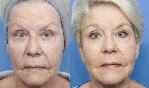 Contour TRL Laser Before & After Gallery - Patient 58214382 - Image 2