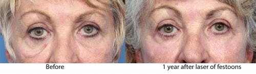 Contour TRL Laser Before & After Gallery - Patient 58214383 - Image 1