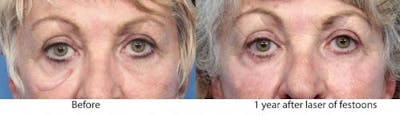 Contour TRL Laser Before & After Gallery - Patient 58214383 - Image 1
