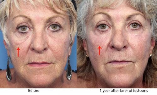 Contour TRL Laser Before & After Gallery - Patient 58214383 - Image 2