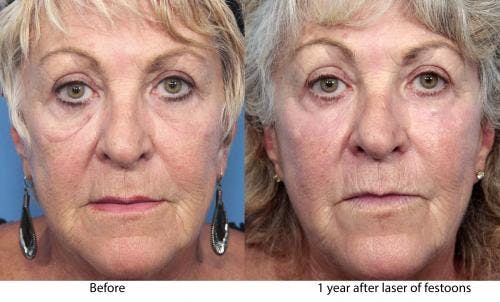 Contour TRL Laser Before & After Gallery - Patient 58214383 - Image 3