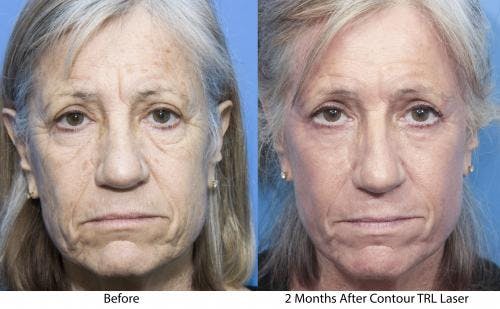 Contour TRL Laser Before & After Gallery - Patient 58214384 - Image 1