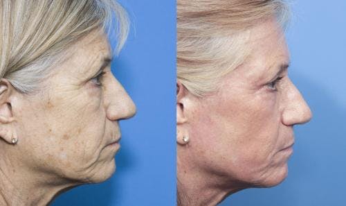 Contour TRL Laser Before & After Gallery - Patient 58214384 - Image 2