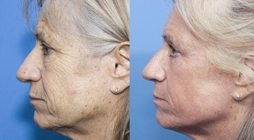 Contour TRL Laser Before & After Gallery - Patient 58214384 - Image 3