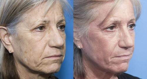 Contour TRL Laser Before & After Gallery - Patient 58214384 - Image 4