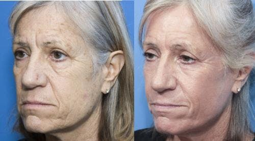 Contour TRL Laser Before & After Gallery - Patient 58214384 - Image 5