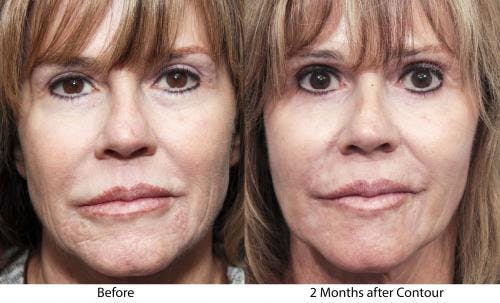 Contour TRL Laser Before & After Gallery - Patient 58214385 - Image 1
