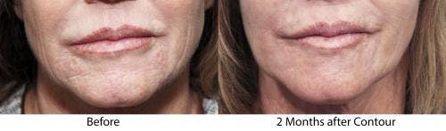 Contour TRL Laser Before & After Gallery - Patient 58214385 - Image 2