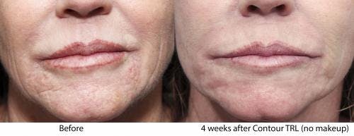 Contour TRL Laser Before & After Gallery - Patient 58214385 - Image 3