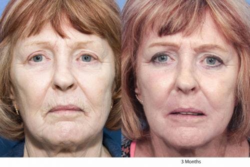 Contour TRL Laser Before & After Gallery - Patient 58214386 - Image 1