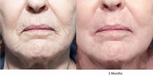 Contour TRL Laser Before & After Gallery - Patient 58214386 - Image 2