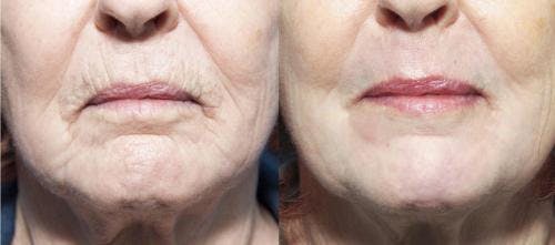 Contour TRL Laser Before & After Gallery - Patient 58214386 - Image 3