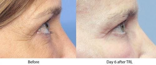 Contour TRL Laser Before & After Gallery - Patient 58214387 - Image 1