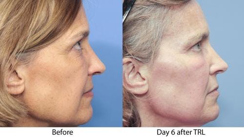 Contour TRL Laser Before & After Gallery - Patient 58214387 - Image 2