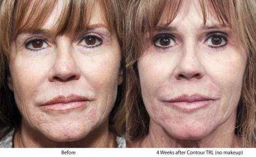 Contour TRL Laser Before & After Gallery - Patient 58214388 - Image 2