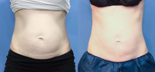Body Before & After Gallery - Patient 58214394 - Image 2