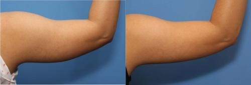 Arms Before & After Gallery - Patient 58214399 - Image 2