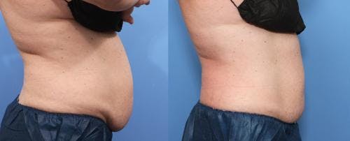 Body Before & After Gallery - Patient 58214401 - Image 1