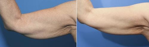 Arms Before & After Gallery - Patient 58214400 - Image 1
