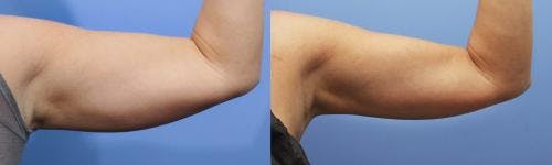 Arms Before & After Gallery - Patient 58214402 - Image 1