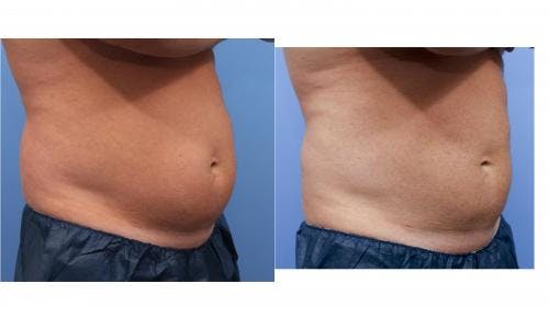 Body Before & After Gallery - Patient 58214404 - Image 1