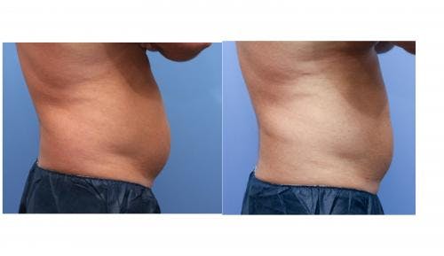 Body Before & After Gallery - Patient 58214404 - Image 3