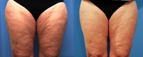 Thighs Before & After Gallery - Patient 58214406 - Image 1