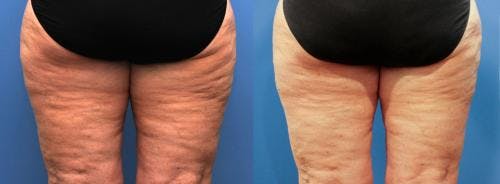 Thighs Before & After Gallery - Patient 58214406 - Image 2